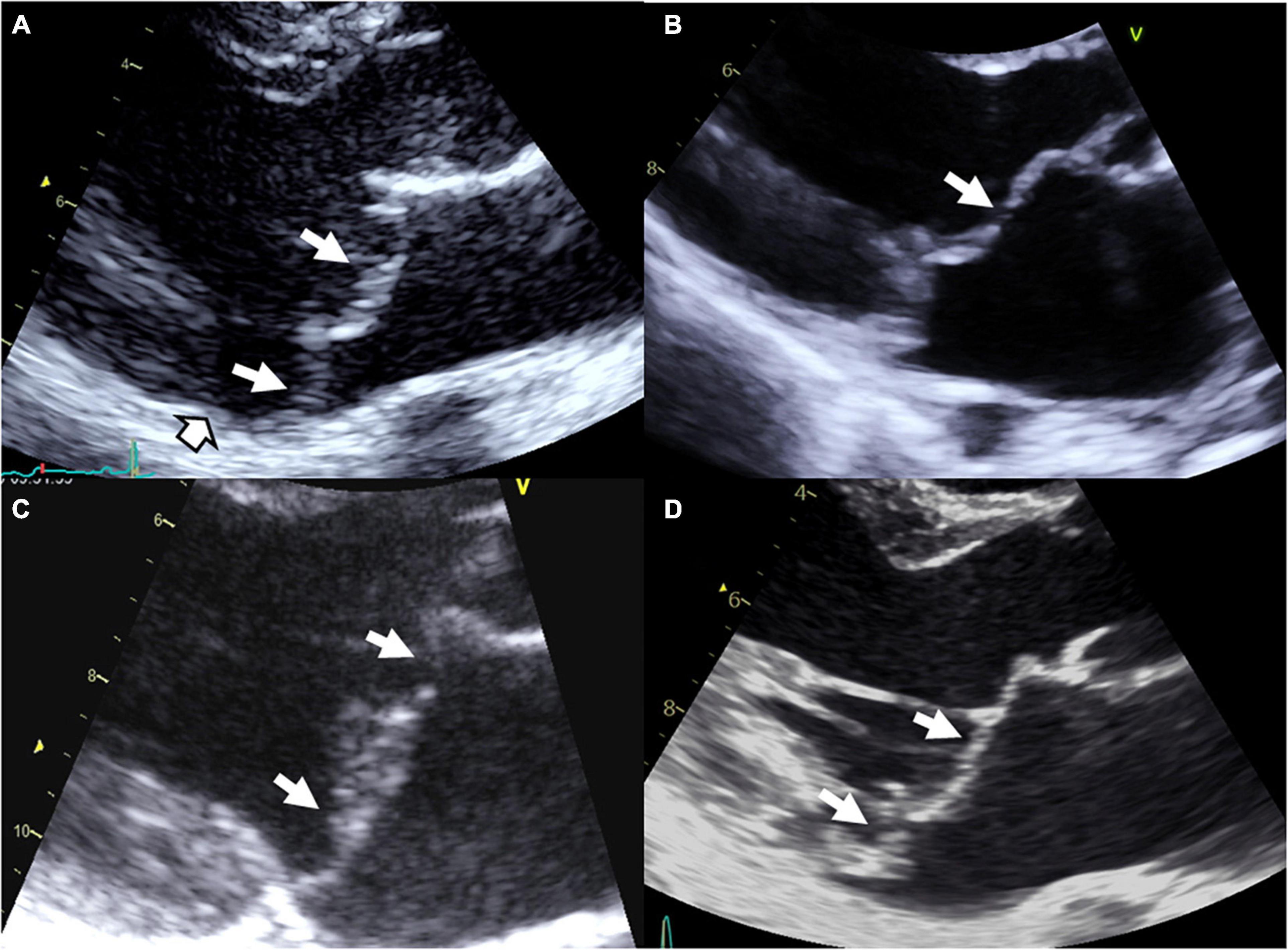 Can Covid Affect Mitral Valve Prolapse